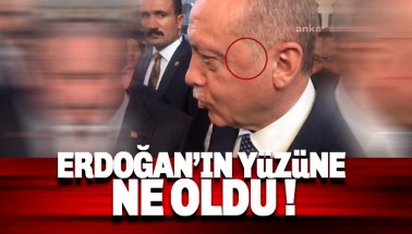 Erdoğan'ın sol şakağındaki şişlik dikkat çekti