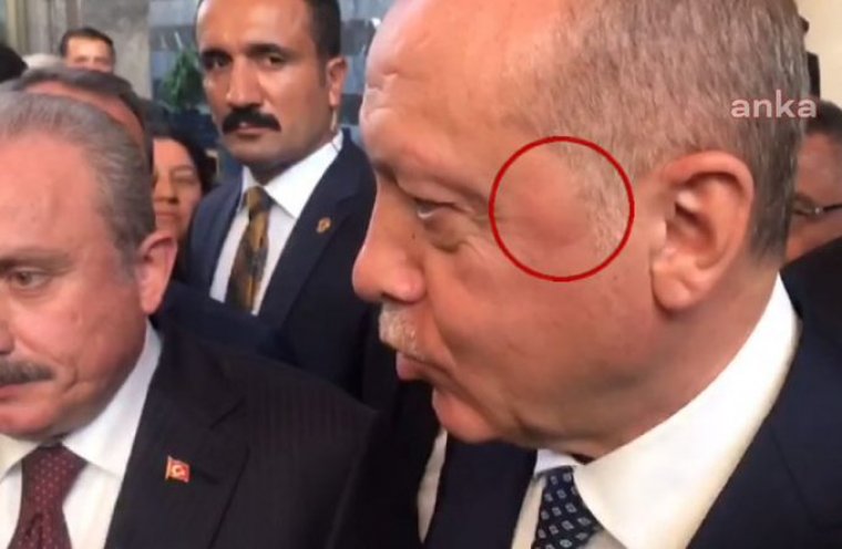 Erdoğan'ın sol şakağındaki şişlik