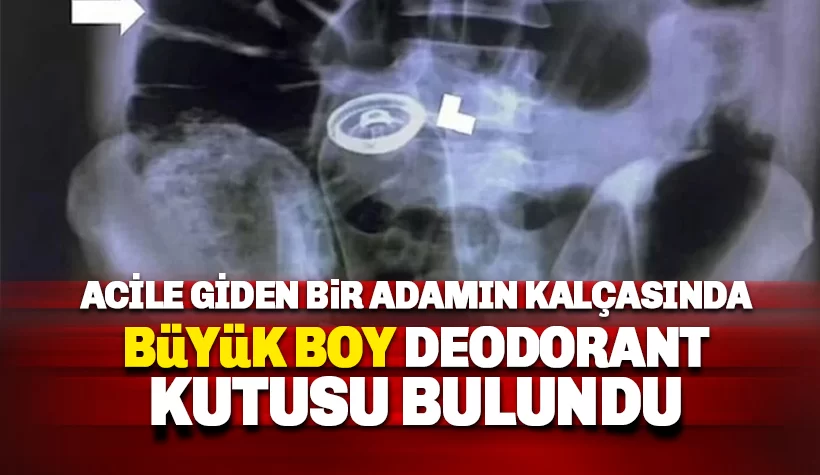 Mide ağrısı şikayetiyle acile gitti: Röntgende Kalçasında deodorant kutusu çıktı