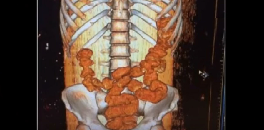 Midesinden prezervatif çıkarılan kadın